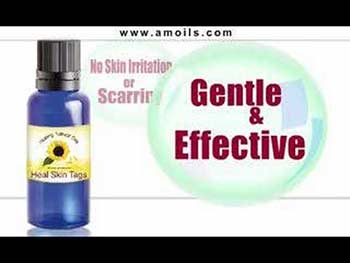 Amolis Skin Tag Remover Review: Gentle And Easy | Remove Skin Tags Now
